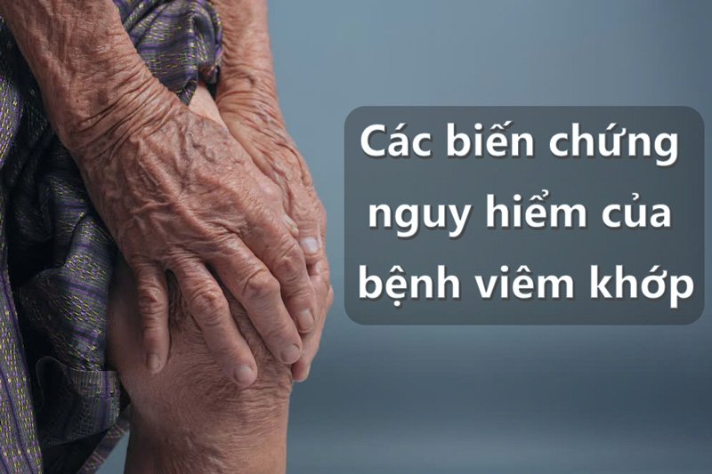 Các biến chứng nguy hiểm của bệnh viêm khớp