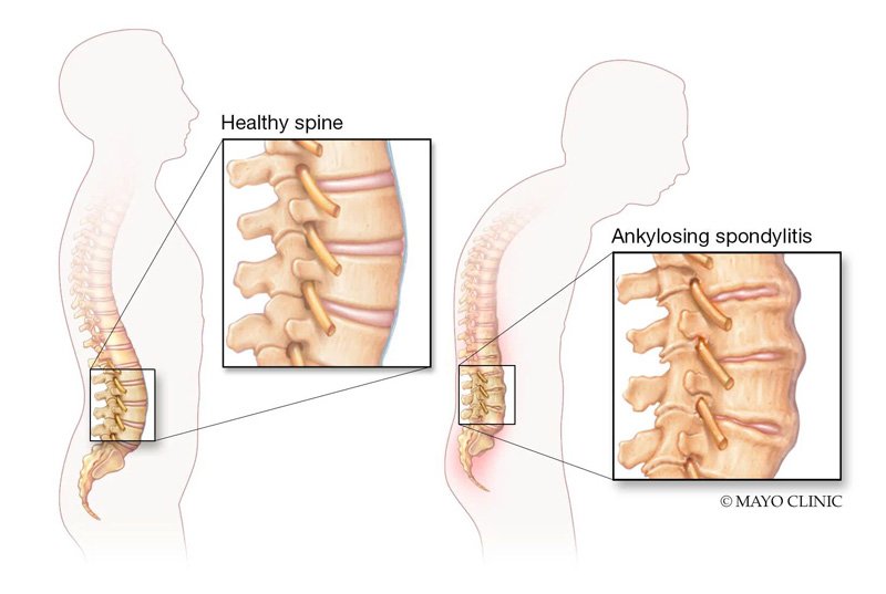 Các dạng viêm khớp thường gặp nhất