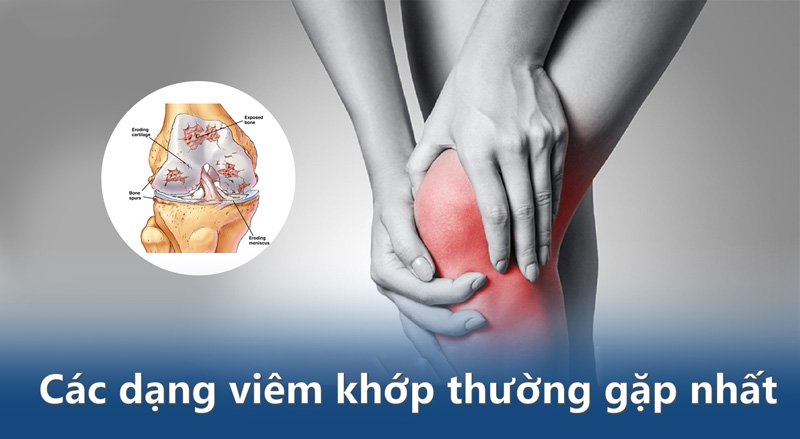 Các dạng viêm khớp thường gặp nhất