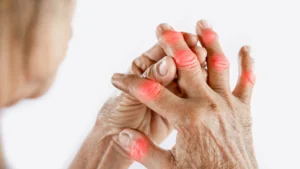 Viêm đa khớp mạn tính là bệnh lý không thể xem nhẹ. Nhận biết sớm các dấu hiệu của bệnh và áp dụng phương pháp điều trị đúng cách sẽ giúp ngăn ngừa các biến chứng nguy hiểm